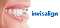 Invisalign Braces
