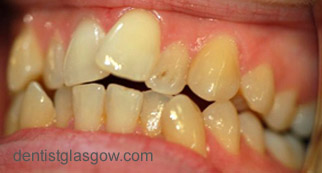 Before   Veneer treatment