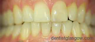 After Implants