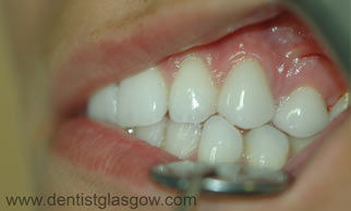 After Implants