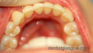 After   Veneer treatment