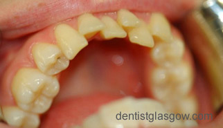 Before   Veneer treatment