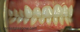 After   Veneer treatment