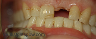 Before   Veneer treatment