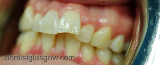 Before   Veneer treatment
