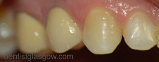 After   Veneer treatment