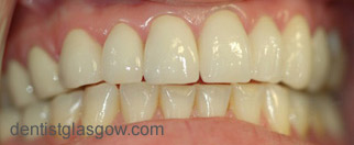 After   Veneer treatment