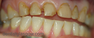 Before   Veneer treatment