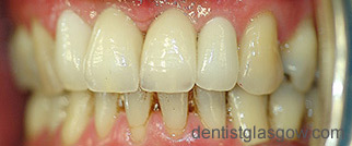 After   Implants
