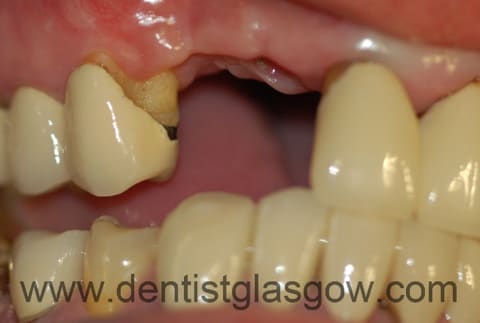 bone loss before implant