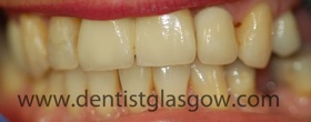 implant and two tooth bridge after