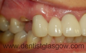 upper dentalimplant 1