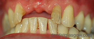 dental implant gallery case8-before