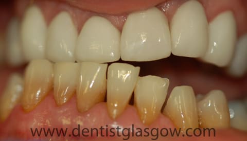 James' teeth after porcelain crowns and veneers