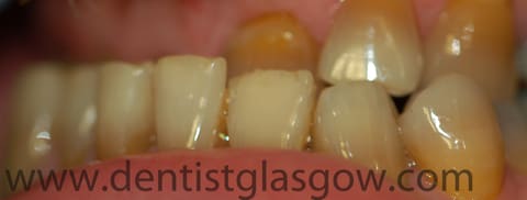 antibiotic discolouration of the teeth