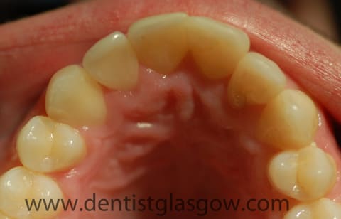 straighter teeth after clear brackets 