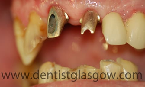 gold abutments on dental implants 
