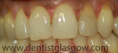 brown upper left lateral incisor
