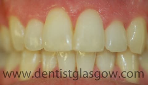 composite bonding on front tooth