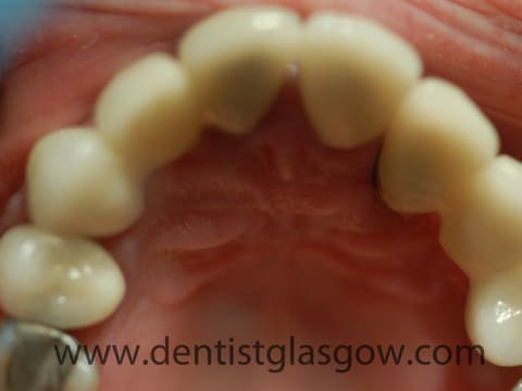 after mini dental implants