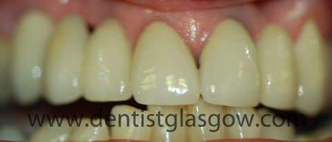 The two mini dental implants supporting porcelain crowns