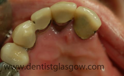 Bone loss meant this patient was a candidate for two mini dental implants