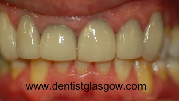 same day veneers 1