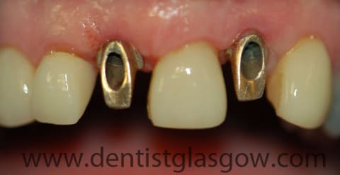 gold abutments