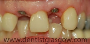 two implants with healing caps 2
