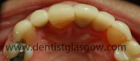 implants on top of gold abutments 2