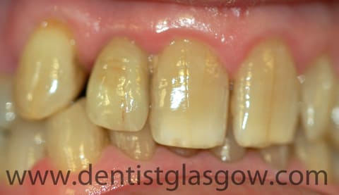 implant crown from the front