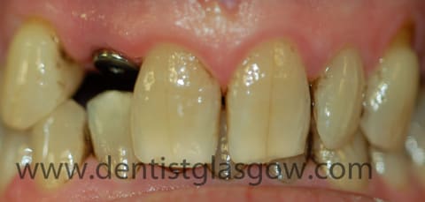 dental implant in place