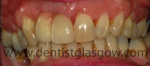 after mini dental implants