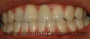 Our patient after the central incisor crown has been fitted