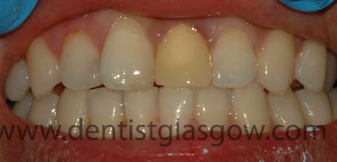 before the central incisor crown