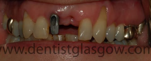 original implant abutment