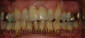 Two teeth implant bridge in place