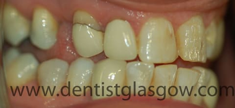 photo of gap between Angela's teeth