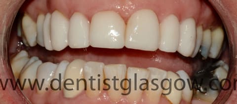 Angela's new veneers