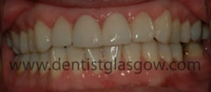 discoloured white fillings 1