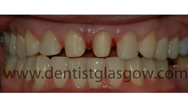 crown and fillings study 1