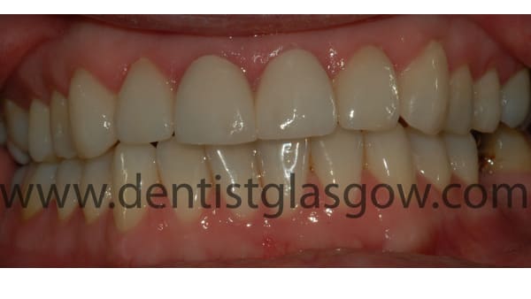 crown and fillings study 2