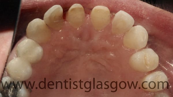 crown and fillings study 3