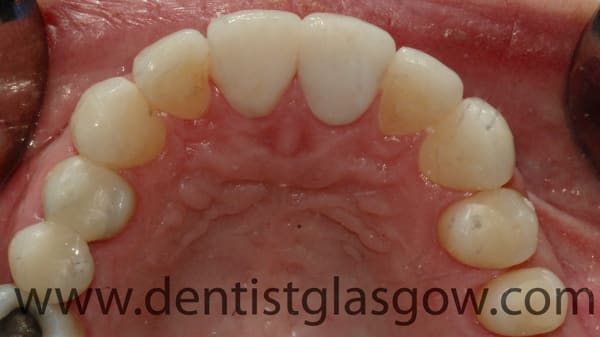 crown and fillings study 4