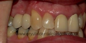implantbridgestudy3