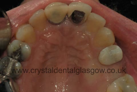 True information about Dental Implants Nhs Criteria
