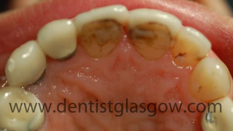 after porcelain bonded crown fitted 2