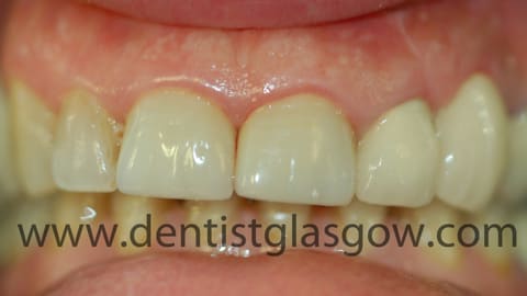 After bone grafts and a porcelain crown