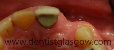 missing tooth and gum loss