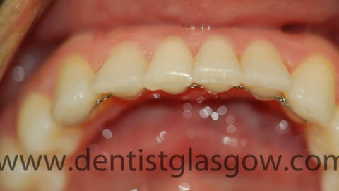 clear braces study after 2